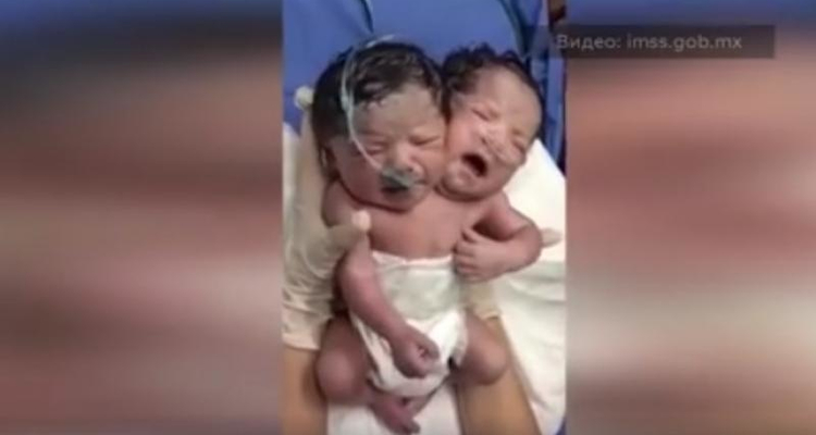 Meksikada ikibaşlı uşaq doğulub <span style="color:#ff0000">VİDEO</span>